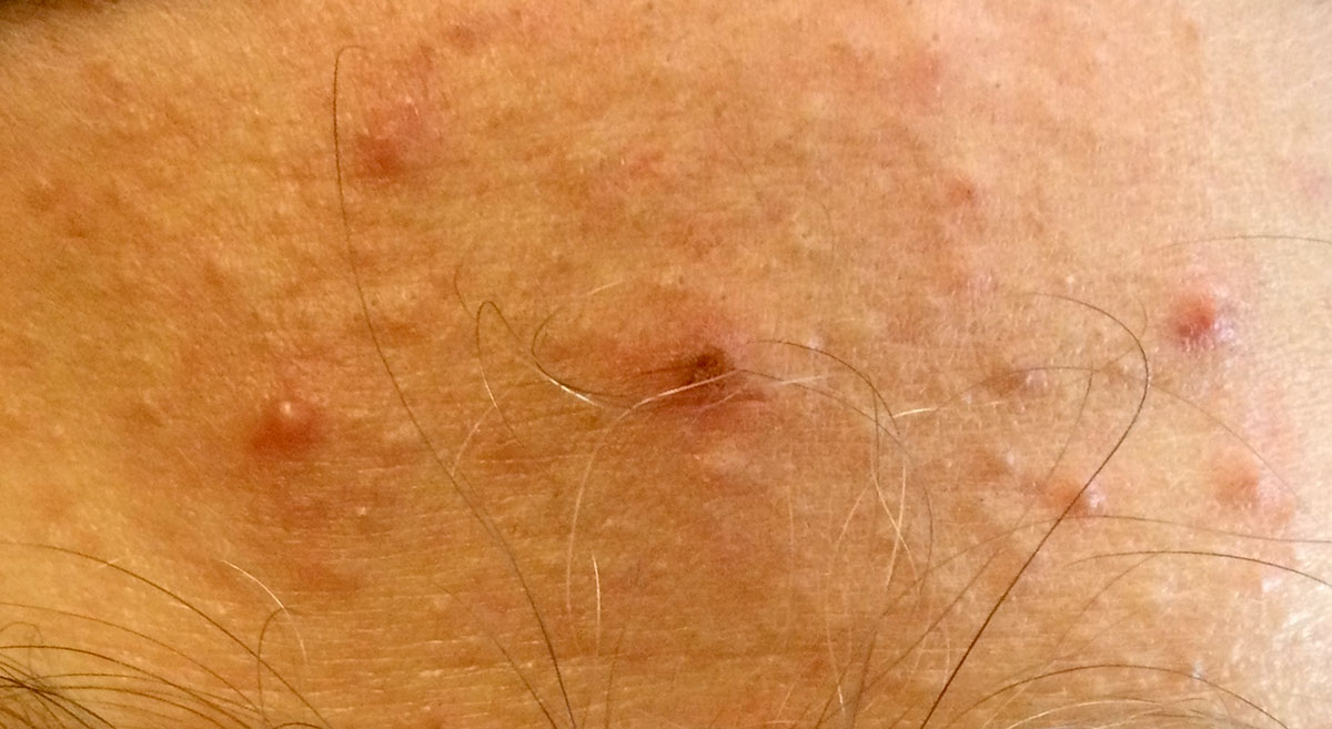 Bacne on the skin