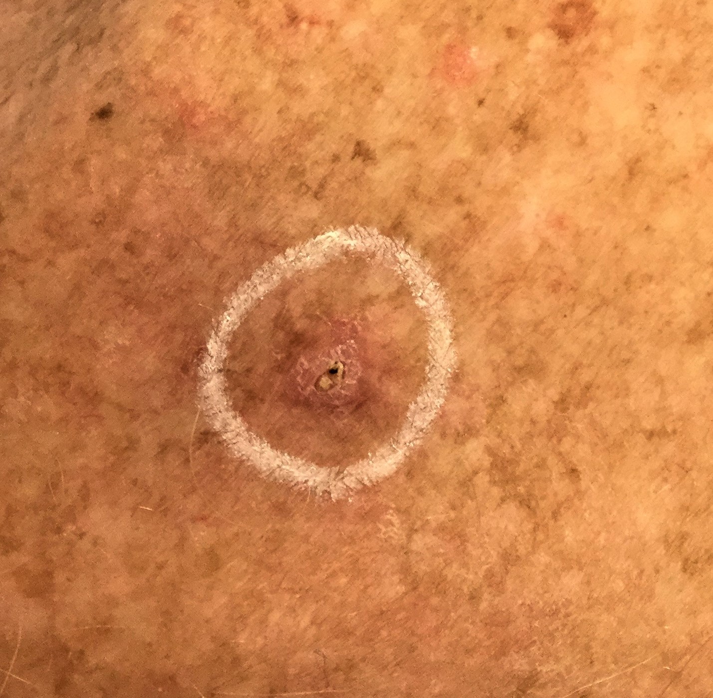 Squamous Cell carcinoma sun damaged skin