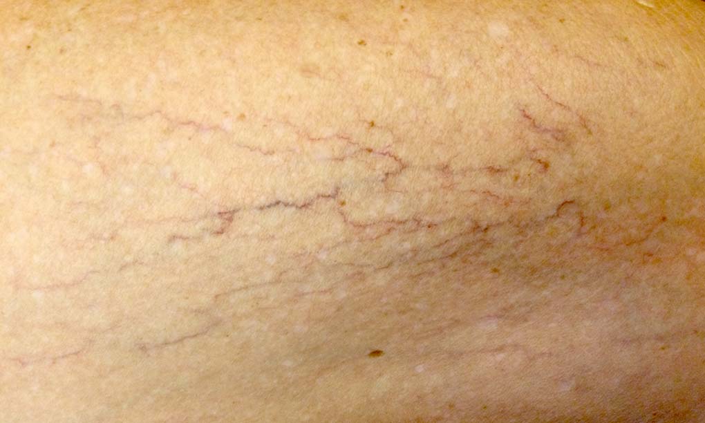 Clinical example of hypertrophic scar showing raised texture