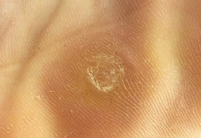 Plantar wart on bottom of foot showing characteristic appearance
