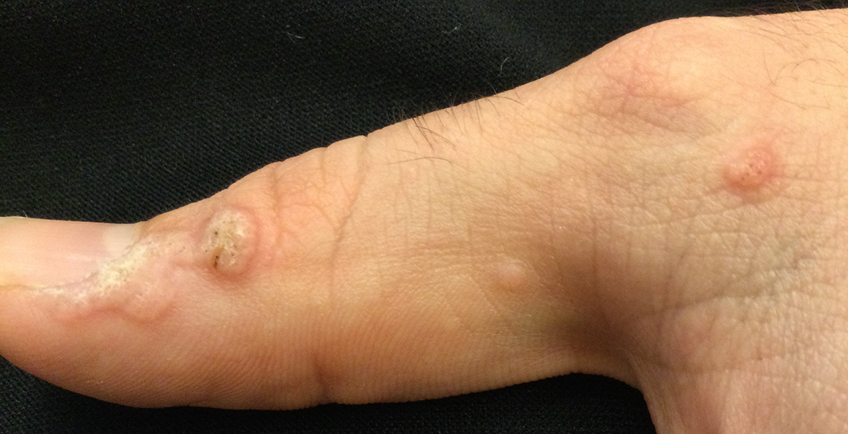 Multiple warts on foot showing viral spread pattern