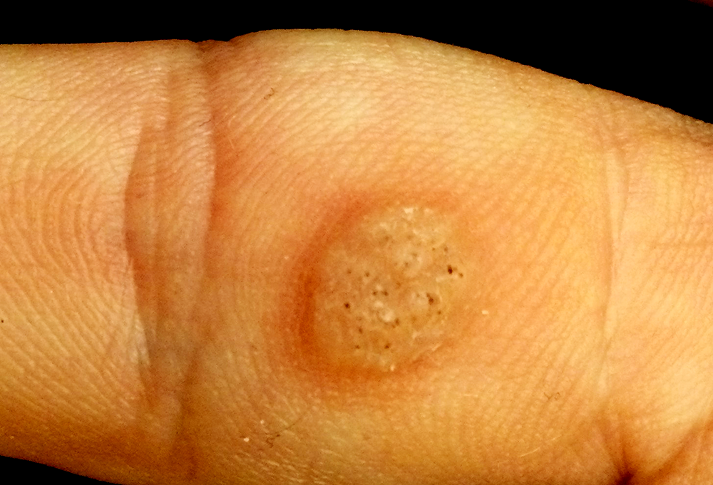 Common wart on finger showing rough thickened surface